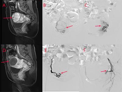 Retrospective Analysis of the Effect of Lidocaine Combined with Methylprednisolone on Pain Control After Uterine Artery Embolization